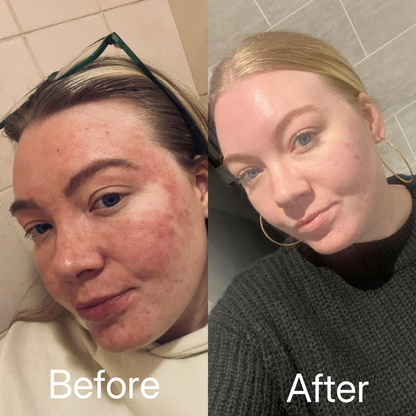100% Pure Organic Castor Oil for Eczema & Psoriasis