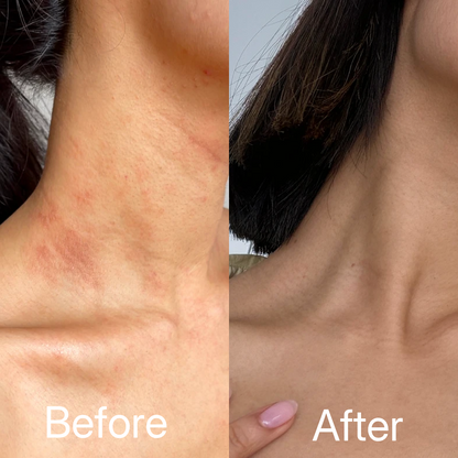 100% Pure Organic Castor Oil for Eczema & Psoriasis