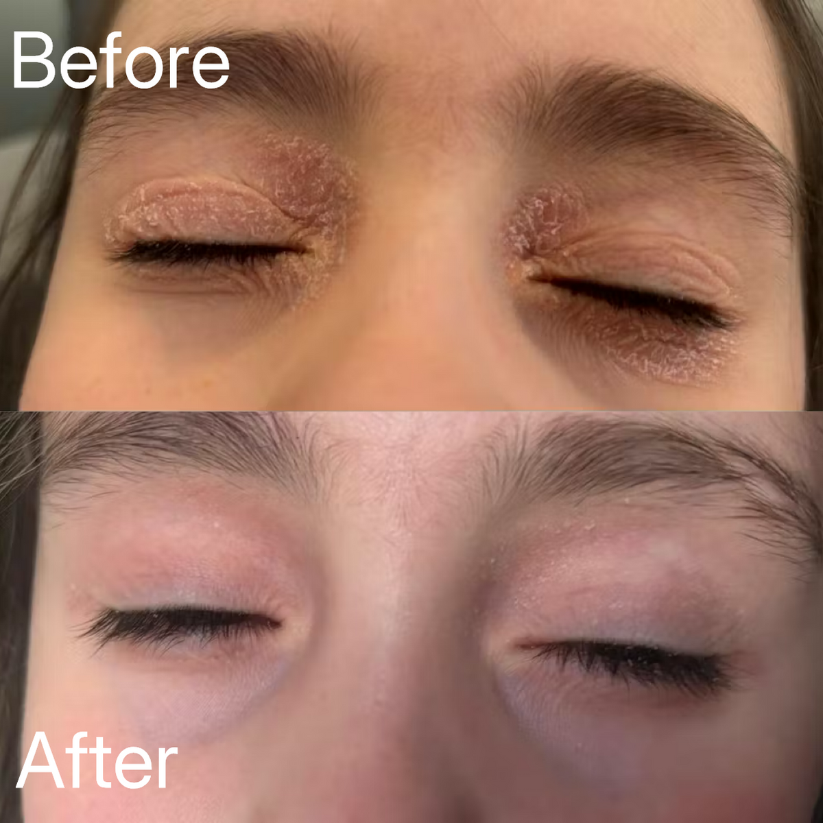 100% Pure Organic Castor Oil for Eczema & Psoriasis