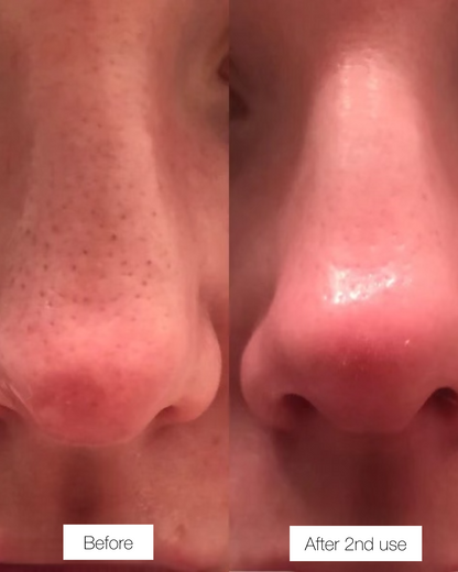 DermaLift™ Nose Patches