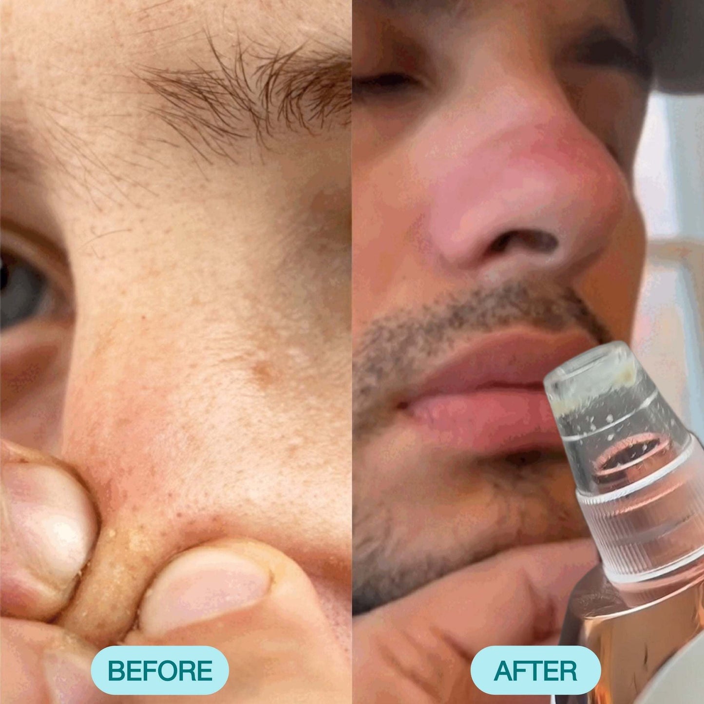 Blackhead Remover Pore Vacuum Cleaner