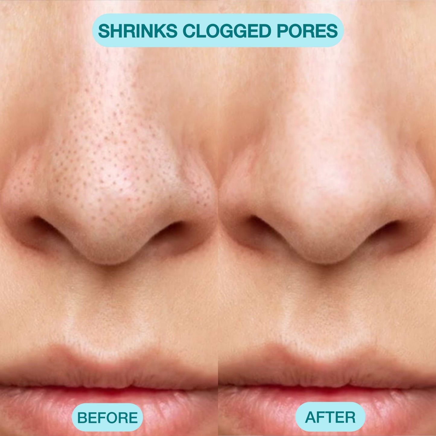 Blackhead Remover Pore Vacuum Cleaner