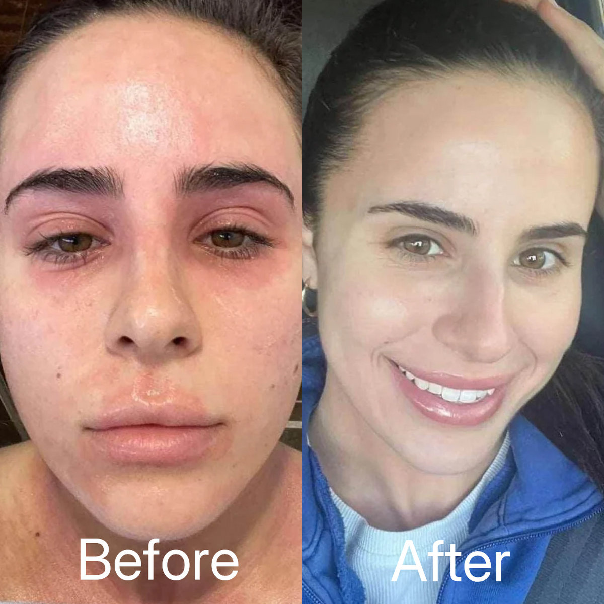 100% Pure Organic Castor Oil for Eczema & Psoriasis