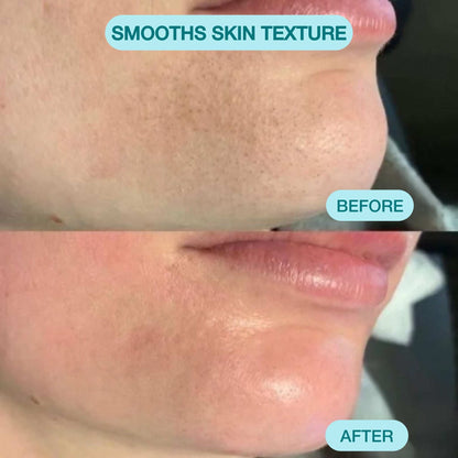 Blackhead Remover Pore Vacuum Cleaner