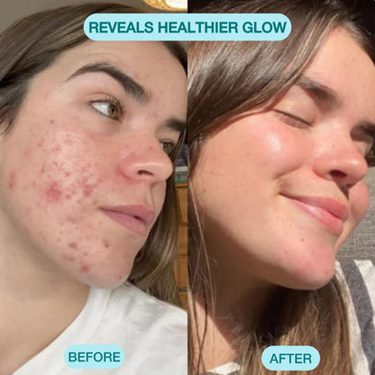 Blackhead Remover Pore Vacuum Cleaner