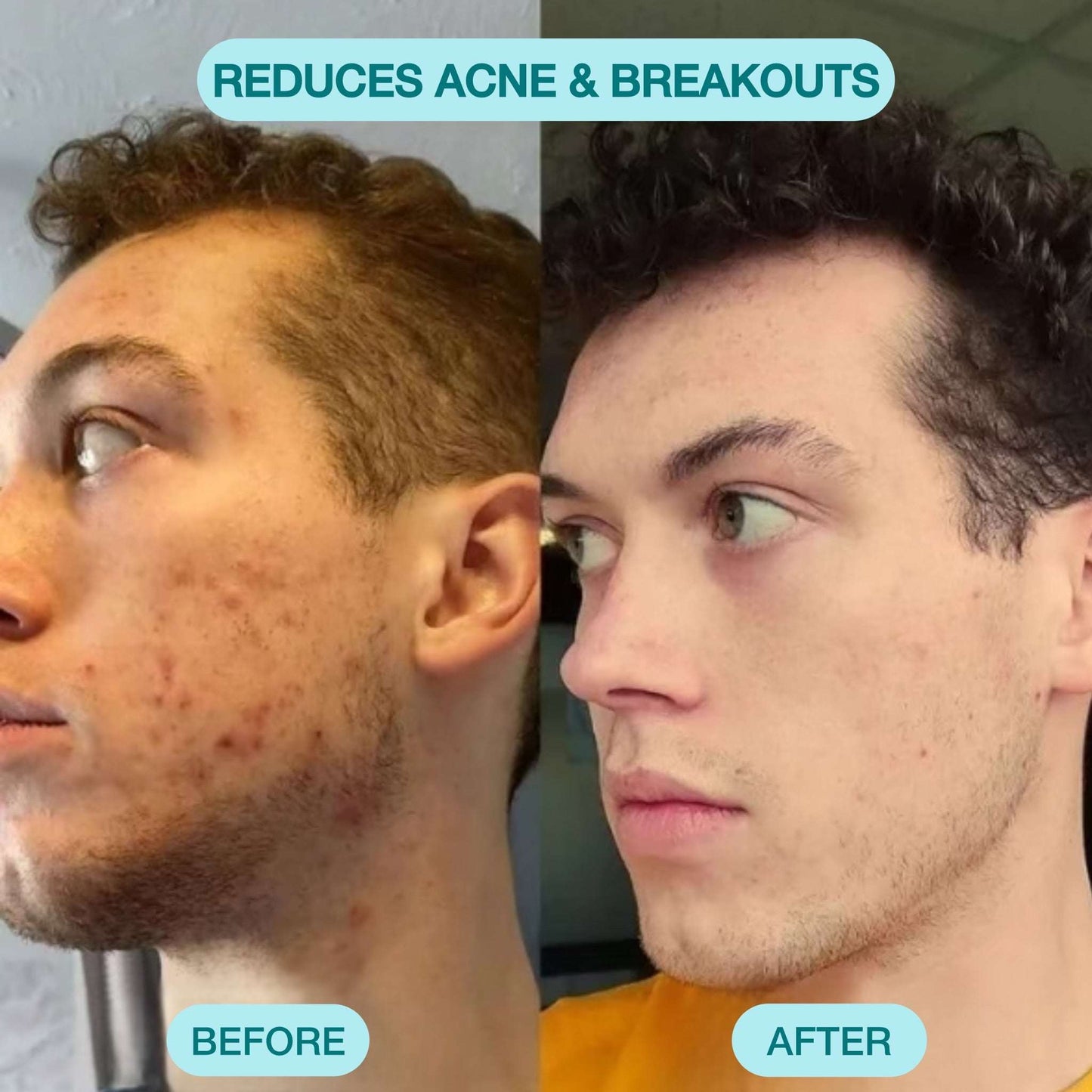 Blackhead Remover Pore Vacuum Cleaner