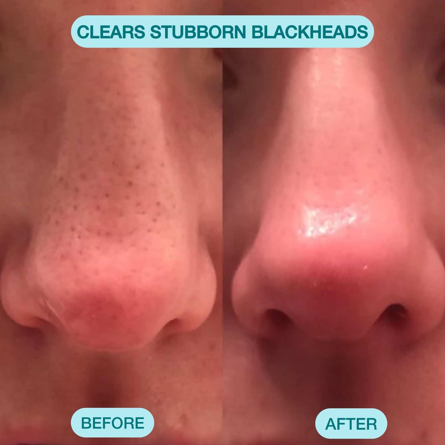 Blackhead Remover Pore Vacuum Cleaner