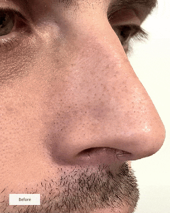 DermaLift™ Nose Patches